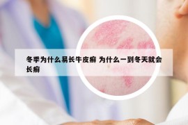 冬季為什么易長(zhǎng)牛皮癬 為什么一到冬天就會(huì)長(zhǎng)癬