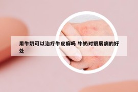 用牛奶可以治療牛皮癬嗎 牛奶對(duì)銀屑病的好處