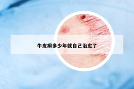 牛皮癬多少年就自己治愈了