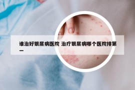 誰治好銀屑病醫(yī)院 治療銀屑病哪個醫(yī)院排第一
