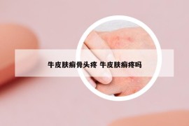 牛皮膚癬骨頭疼 牛皮膚癬疼嗎