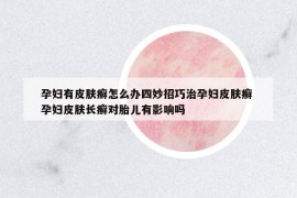 孕婦有皮膚癬怎么辦四妙招巧治孕婦皮膚癬 孕婦皮膚長癬對胎兒有影響嗎