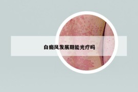 白癜風發(fā)展期能光療嗎