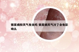 銀屑病和天氣有關(guān)嗎 銀屑病天氣冷了會有影響么