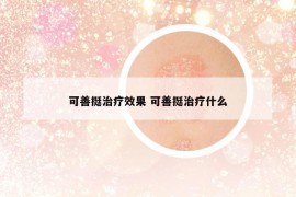 可善挺治療效果 可善挺治療什么