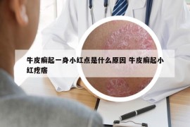 牛皮癬起一身小紅點(diǎn)是什么原因 牛皮癬起小紅疙瘩