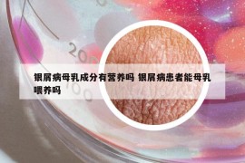 銀屑病母乳成分有營(yíng)養(yǎng)嗎 銀屑病患者能母乳喂養(yǎng)嗎