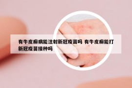 有牛皮癬病能注射新冠疫苗嗎 有牛皮癬能打新冠疫苗接種嗎