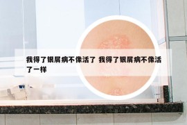 我得了銀屑病不像活了 我得了銀屑病不像活了一樣