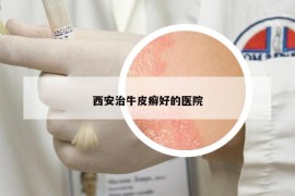 西安治牛皮癬好的醫(yī)院