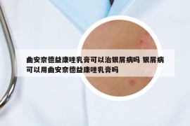 曲安奈德益康唑乳膏可以治銀屑病嗎 銀屑病可以用曲安奈德益康唑乳膏嗎