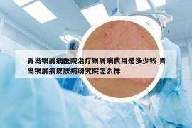 青島銀屑病醫(yī)院治療銀屑病費(fèi)用是多少錢(qián) 青島銀屑病皮膚病研究院怎么樣