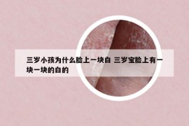 三歲小孩為什么臉上一塊白 三歲寶臉上有一塊一塊的白的