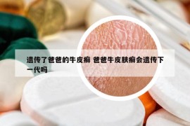 遺傳了爸爸的牛皮癬 爸爸牛皮膚癬會(huì)遺傳下一代嗎