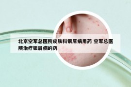 北京空軍總醫(yī)院皮膚科銀屑病用藥 空軍總醫(yī)院治療銀屑病的藥