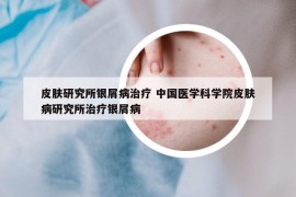 皮膚研究所銀屑病治療 中國醫(yī)學(xué)科學(xué)院皮膚病研究所治療銀屑病