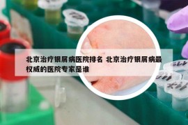 北京治療銀屑病醫(yī)院排名 北京治療銀屑病最權(quán)威的醫(yī)院專家是誰