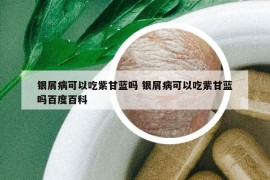 銀屑病可以吃紫甘藍(lán)嗎 銀屑病可以吃紫甘藍(lán)嗎百度百科