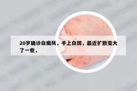 20歲確診白癜風，手上白斑，最近擴散變大了一些，