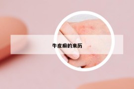 牛皮癬的來歷