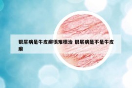 銀屑病是牛皮癬很難根治 銀屑病是不是牛皮廨