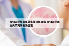 當(dāng)歸四逆加吳茱萸生姜湯銀屑病 當(dāng)歸四逆湯加吳茱萸生姜湯醫(yī)案