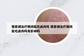 銀屑病治療期間能吃鹵肉嗎 銀屑病治療期間能吃鹵肉嗎有影響嗎