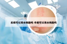 皮癬可以用水楊酸嗎 手癬可以用水楊酸嗎