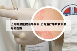 上海哪里醫(yī)院治牛皮癬 上海治療牛皮膚癬最好的醫(yī)院