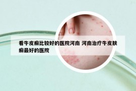 看牛皮癬比較好的醫(yī)院河南 河南治療牛皮膚癬最好的醫(yī)院