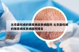 北京最權(quán)威的銀屑病皮膚病醫(yī)院 北京最權(quán)威的銀屑病皮膚病醫(yī)院排名