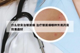 什么軟膏治銀屑病 治療銀屑病哪種外用藥膏效果最好