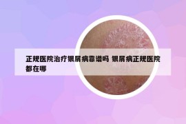 正規(guī)醫(yī)院治療銀屑病靠譜嗎 銀屑病正規(guī)醫(yī)院都在哪