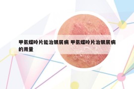 甲氨蝶呤片能治銀屑病 甲氨蝶呤片治銀屑病的用量