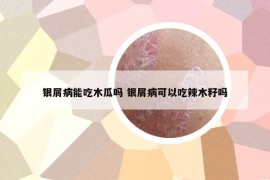 銀屑病能吃木瓜嗎 銀屑病可以吃辣木籽嗎