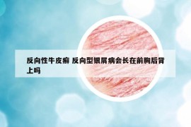 反向性牛皮癬 反向型銀屑病會(huì)長在前胸后背上嗎