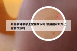 銀屑病可以早上空腹飲水嗎 銀屑病可以早上空腹飲水嗎