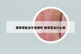 狼毒草能治牛皮癬嗎 狼毒草治什么病