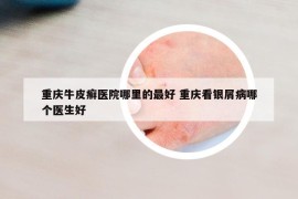 重慶牛皮癬醫(yī)院哪里的最好 重慶看銀屑病哪個醫(yī)生好