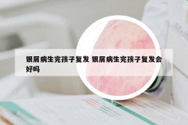 銀屑病生完孩子復(fù)發(fā) 銀屑病生完孩子復(fù)發(fā)會好嗎