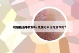 硫酸能治牛皮癬嗎 硫酸可以治療腳氣嗎?
