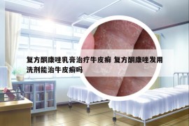 復方酮康唑乳膏治療牛皮癬 復方酮康唑發(fā)用洗劑能治牛皮癬嗎