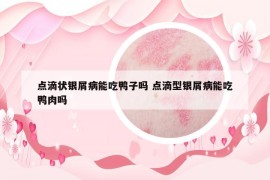 點(diǎn)滴狀銀屑病能吃鴨子嗎 點(diǎn)滴型銀屑病能吃鴨肉嗎