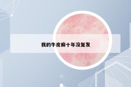 我的牛皮癬十年沒復(fù)發(fā)