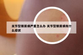 關(guān)節(jié)型銀屑病嚴(yán)重怎么辦 關(guān)節(jié)型銀屑病有什么癥狀