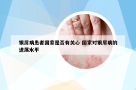 銀屑病患者國家是否有關(guān)心 國家對銀屑病的進(jìn)展水平