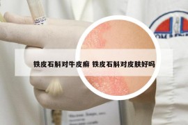 鐵皮石斛對牛皮癬 鐵皮石斛對皮膚好嗎