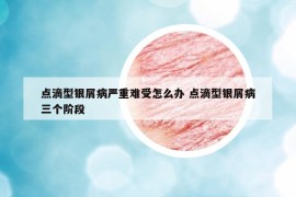 點(diǎn)滴型銀屑病嚴(yán)重難受怎么辦 點(diǎn)滴型銀屑病三個(gè)階段