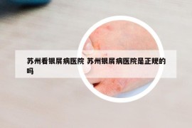 蘇州看銀屑病醫(yī)院 蘇州銀屑病醫(yī)院是正規(guī)的嗎