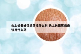 頭上長(zhǎng)著好像銀屑掛什么科 頭上長(zhǎng)銀屑病應(yīng)該用什么藥